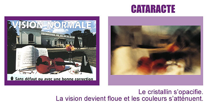 vision cataracte