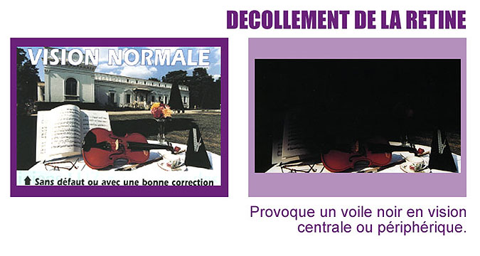 vision décollement de la rétine