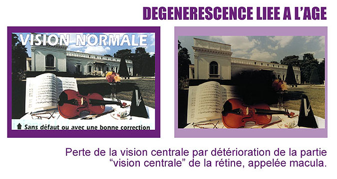 vision dégénérescence liée à l'age