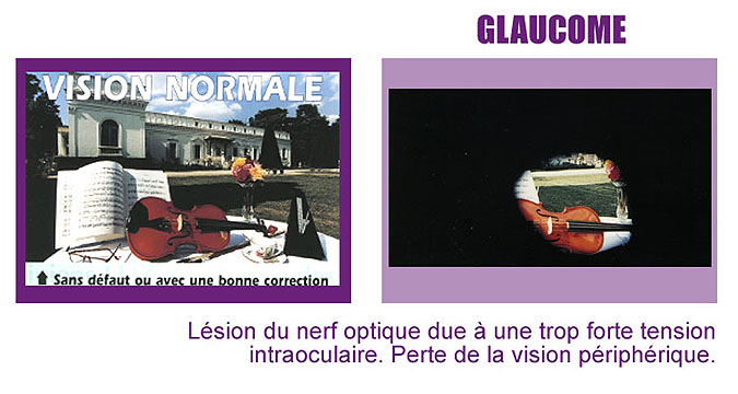 vision glaucome