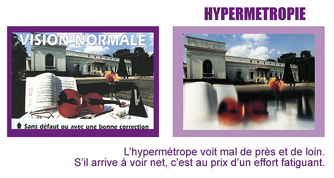 vision hypermétropie